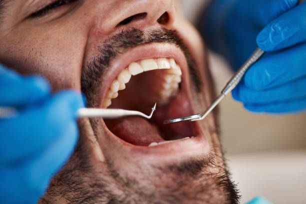 Best Emergency Wisdom Teeth Removal in Keyport, NJ