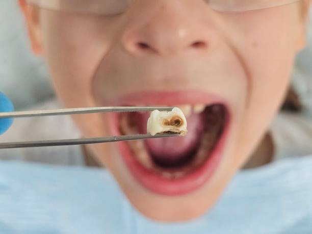 Best Emergency Tooth Extraction in Keyport, NJ